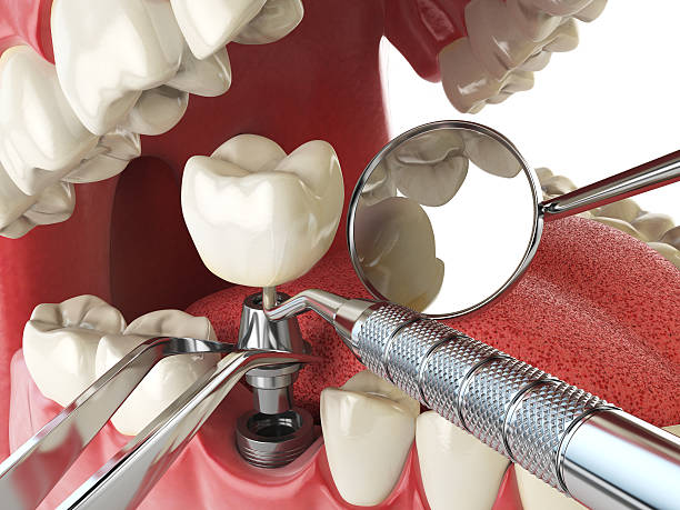 Best Emergency Dentist for Knocked-Out Tooth in Iowa, LA